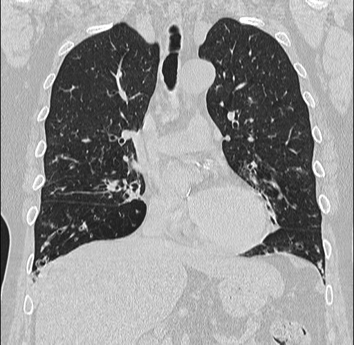 Alpha-1-antitrypsin deficiency (Radiopaedia 72058-82557 Coronal lung window 33).jpg