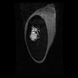 Alveolar soft part sarcoma (Radiopaedia 64501-73678 D 125).jpg