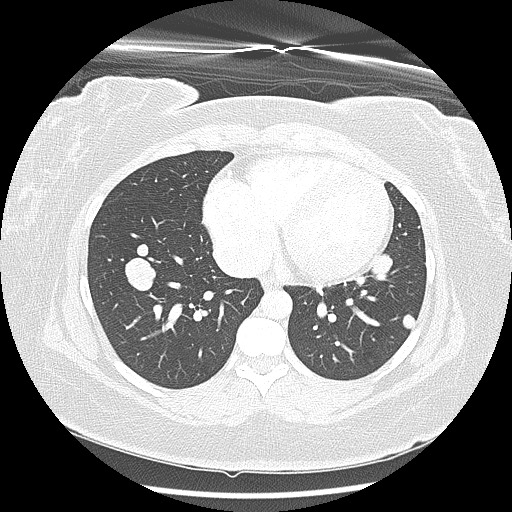Alveolar soft part sarcoma - right leg (Radiopaedia 59432-67091 Axial lung window 77).jpg