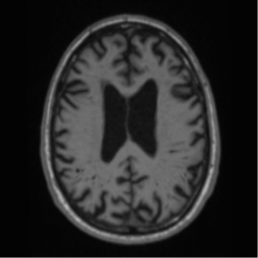 Alzheimer's disease- with Gerstmann syndrome and dressing apraxia (Radiopaedia 54882-61150 Axial T1 49).png