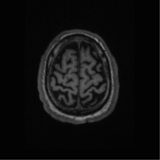 Alzheimer disease - probable (Radiopaedia 35334-36837 Axial T1 64).png