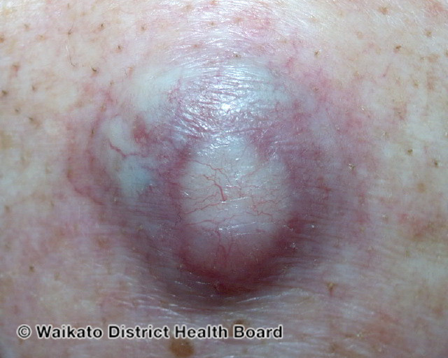 File:Amelanotic melanoma (DermNet NZ amelanotic-melanoma-033).jpg
