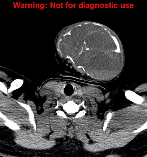 File:Ameloblastoma (Radiopaedia 33126-34164 A 30).jpg