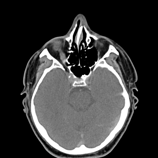Ameloblastoma (Radiopaedia 38520-40623 Axial non-contrast 7).png