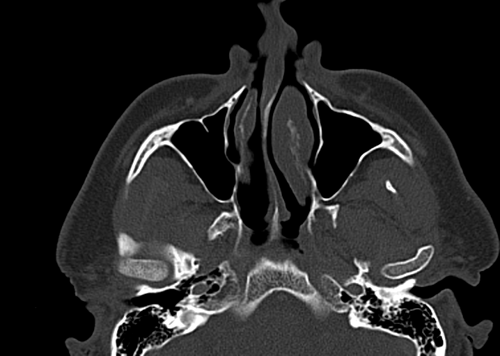 Ameloblastoma (Radiopaedia 38520-40623 D 15).png