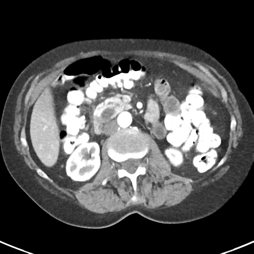 Ampullary adenocarcinoma (Radiopaedia 34013-35237 B 41).png