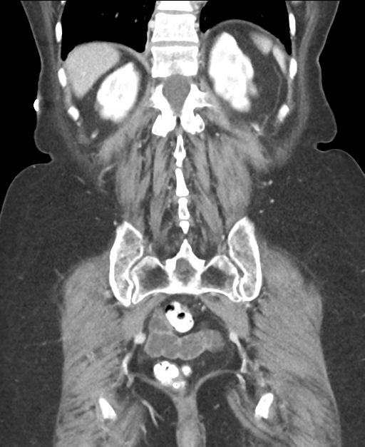Ampullary adenocarcinoma (Radiopaedia 34013-35237 E 40).png
