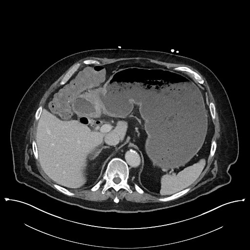 Ampullary adenocarcinoma (Radiopaedia 59373-66737 A 44).jpg