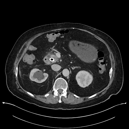 Ampullary adenocarcinoma (Radiopaedia 59373-66737 A 62).jpg