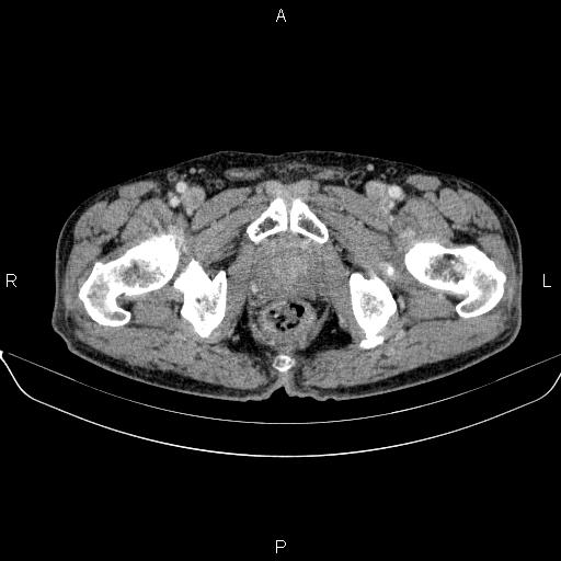 File:Ampullary adenocarcinoma (Radiopaedia 86093-102032 A 57).jpg