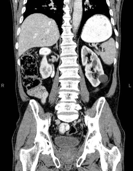 Ampullary adenocarcinoma (Radiopaedia 86093-102032 C 44).jpg