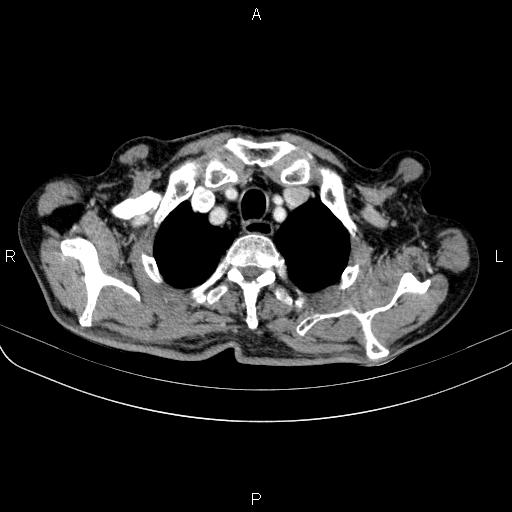 Ampullary adenocarcinoma (Radiopaedia 86093-102033 B 16).jpg