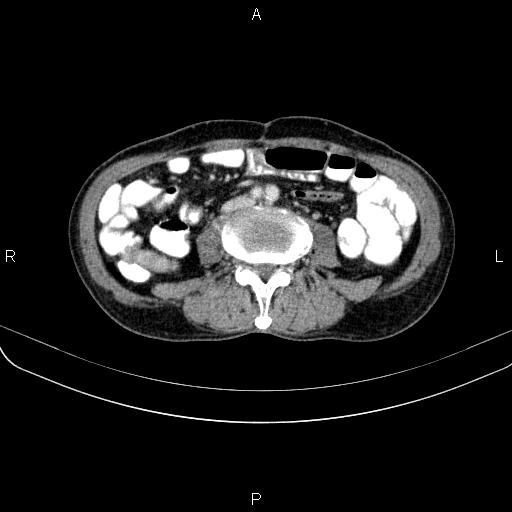 Ampullary adenocarcinoma (Radiopaedia 86093-102033 B 78).jpg
