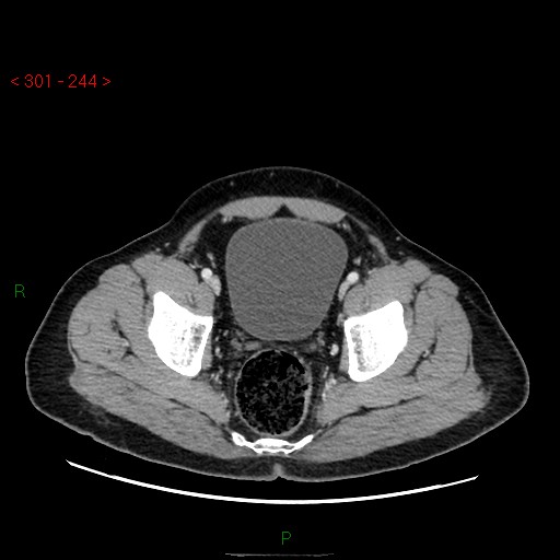 File:Ampullary carcinoma (Radiopaedia 56396-63056 C 90).jpg