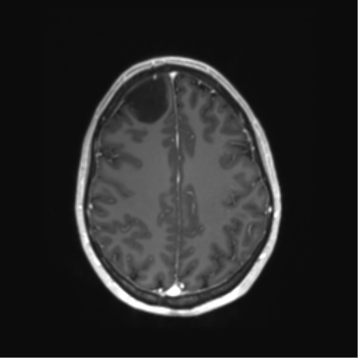File:Anaplastic astrocytoma IDH mutant (Radiopaedia 50046-55341 Axial T1 C+ 36).png
