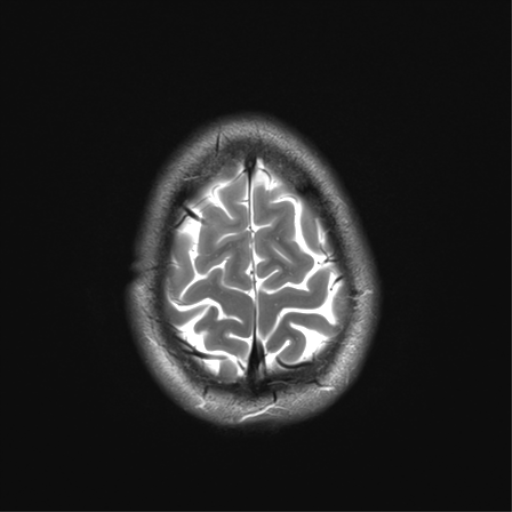 File:Anaplastic astrocytoma IDH mutant (Radiopaedia 50046-55341 Axial T2 34).png