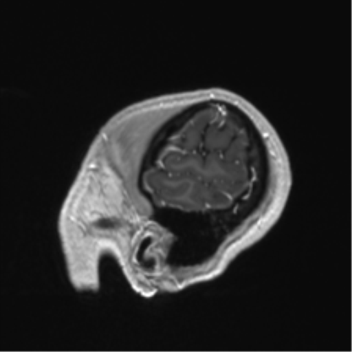 Anaplastic astrocytoma IDH mutant (Radiopaedia 50046-55341 Sagittal T1 C+ 12).png