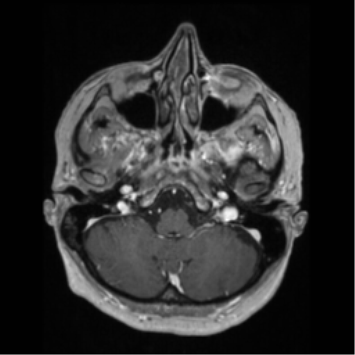 File:Anaplastic astrocytoma IDH wild-type (pseudoprogression) (Radiopaedia 42209-45276 Axial T1 C+ 34).png