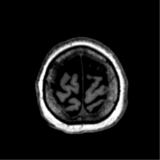 Anaplastic astrocytoma IDH wild-type (pseudoprogression) (Radiopaedia 42209-45277 Axial T1 121).png