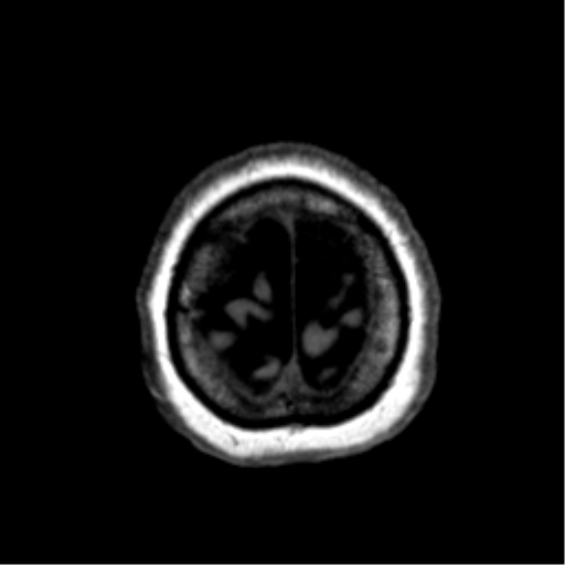 Anaplastic astrocytoma IDH wild-type (pseudoprogression) (Radiopaedia 42209-45277 Axial T1 125).png