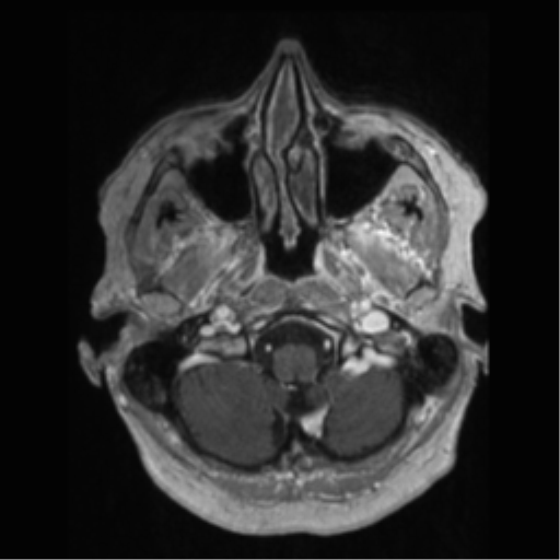 File:Anaplastic astrocytoma IDH wild-type (pseudoprogression) (Radiopaedia 42209-45277 Axial T1 C+ 11).png