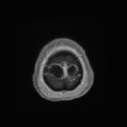 File:Anaplastic astrocytoma IDH wild-type (pseudoprogression) (Radiopaedia 42209-45278 Axial T1 C+ 147).png