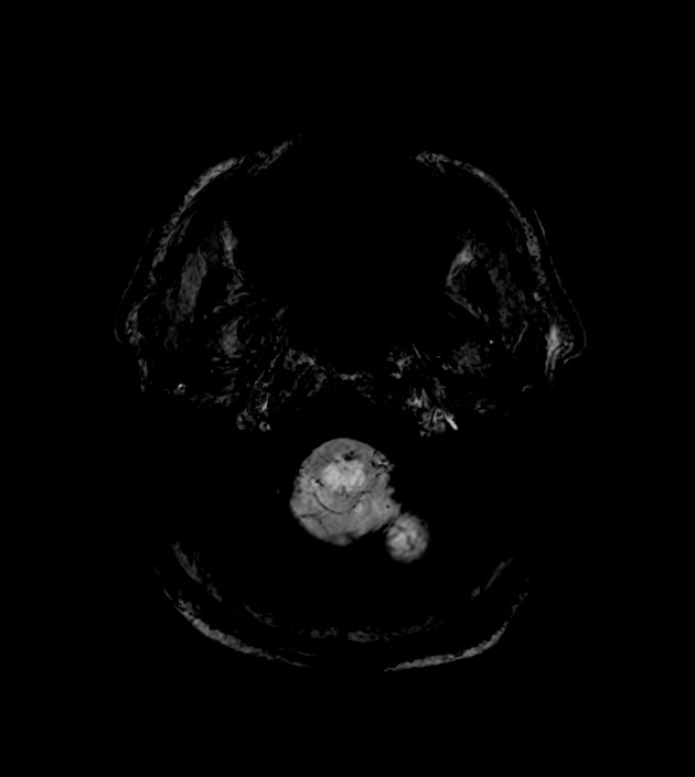 Anaplastic oligodendroglioma (Radiopaedia 79571-92754 F 9).jpg