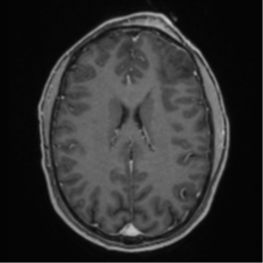 Anaplastic oligodendroglioma with skull fracture (Radiopaedia 74831-85845 Axial T1 C+ fat sat 39).png