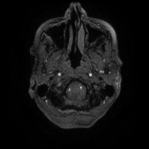 Aneurysm of the terminal internal carotid artery (Radiopaedia 88167-104764 H 9).jpg