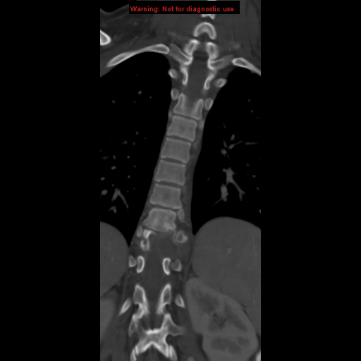 File:Aneurysmal bone cyst (Radiopaedia 9419-10102 Coronal bone window 12).jpg