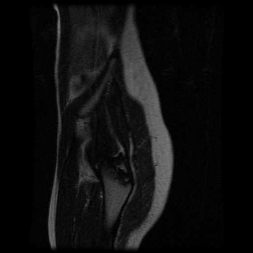 File:Aneurysmal bone cyst - sacrum (Radiopaedia 65190-74196 Sagittal T2 32).jpg