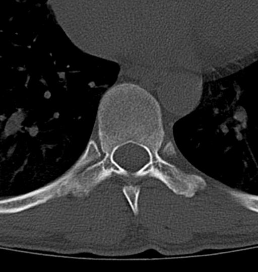 Aneurysmal bone cyst T11 (Radiopaedia 29294-29721 Axial bone window 21).jpg