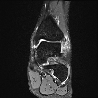 File:Ankle syndesmotic injury (Radiopaedia 69066-78837 Coronal PD fat sat 36).jpg
