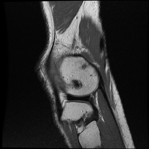 Anomalous insertion of the medial meniscus (Radiopaedia 77559-89721 Sagittal PD 11).jpg