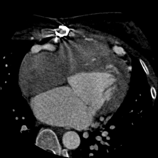 File:Anomalous left coronary artery from the pulmonary artery (ALCAPA) (Radiopaedia 40884-43586 A 40).jpg