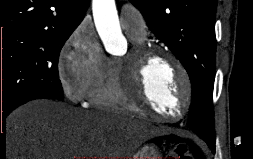 Anomalous left coronary artery from the pulmonary artery (ALCAPA) (Radiopaedia 70148-80181 B 108).jpg