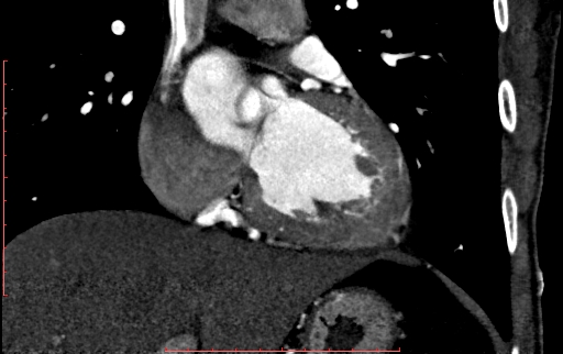 Anomalous left coronary artery from the pulmonary artery (ALCAPA) (Radiopaedia 70148-80181 B 153).jpg