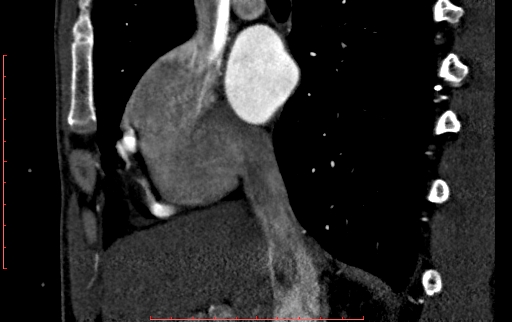 Anomalous left coronary artery from the pulmonary artery (ALCAPA) (Radiopaedia 70148-80181 C 44).jpg