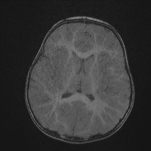 Anoxic brain injury (Radiopaedia 79165-92139 Axial MRA 147).jpg