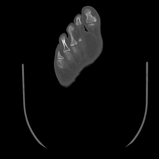 Anterior calcaneal process fracture (Radiopaedia 82590-96762 Axial bone window 45).jpg