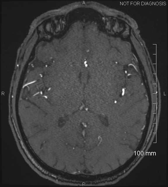 Anterior cerebral artery aneurysm (Radiopaedia 80683-94127 Axial MRA 132).jpg