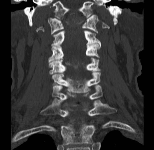 Anterior cervical postdiscectomy arthrodesis (Radiopaedia 32678-33646 Coronal bone window 30).jpg