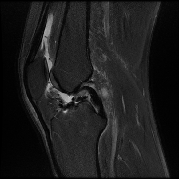 File:Anterior cruciate ligament graft tear and bucket-handle tear of medial meniscus (Radiopaedia 75867-87255 Sagittal PD fat sat 14).jpg