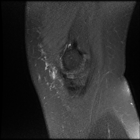 File:Anterior cruciate ligament tear, Wrisberg rip and bucket-handle tear of medial meniscus (Radiopaedia 75872-87266 Sagittal PD fat sat 24).jpg