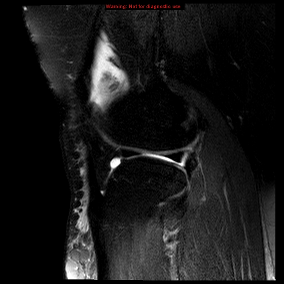 File:Anterior cruciate ligament tear (Radiopaedia 12329-12612 E 5).jpg