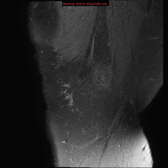 File:Anterior cruciate ligament tear - complete (Radiopaedia 12175-12514 Sagittal T2 fat sat 22).jpg