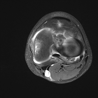 File:Anterior cruciate ligament tear - pediatric (Radiopaedia 62152-70260 Axial PD fat sat 23).jpg