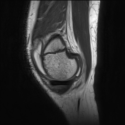 Anterior cruciate ligament tear - pediatric (Radiopaedia 62152-70260 Sagittal PD 33).jpg