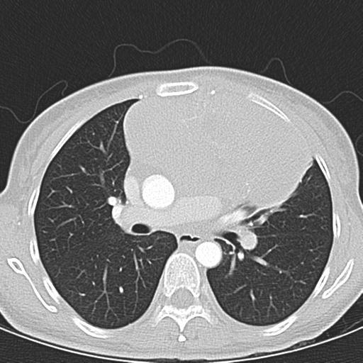 Anterior mediastinal lymphoma (Radiopaedia 29556-30061 Axial lung window 25).jpg