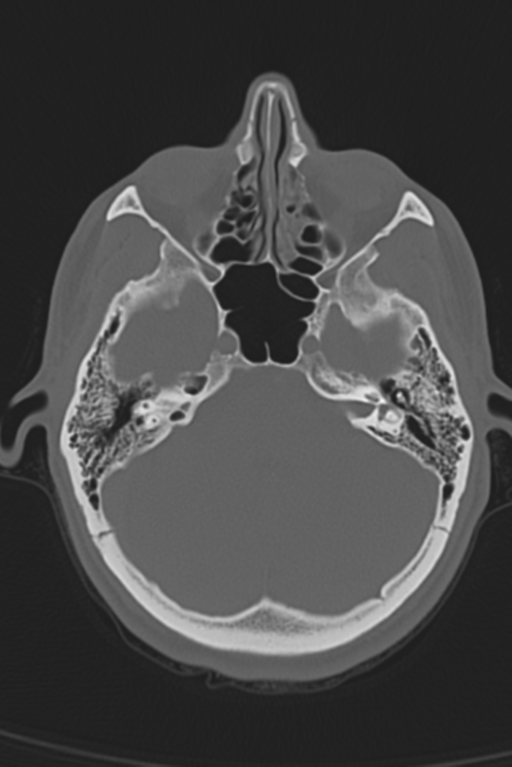 Anterior nasal spine fracture (Radiopaedia 46138-50494 Axial bone window 42).png